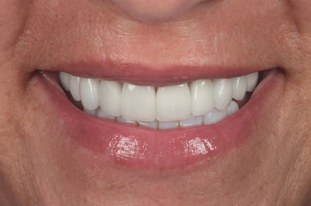 Porcelain Veneers after