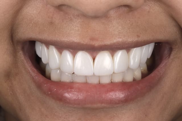 Teeth Whitening after