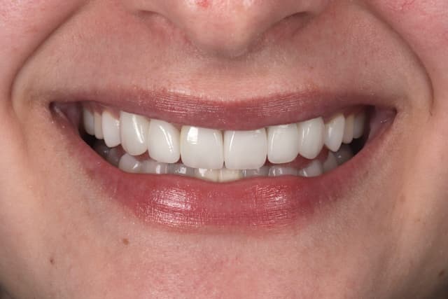 Porcelain Veneers after