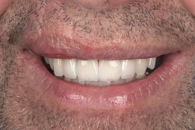 Porcelain Veneers after