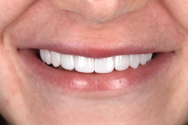Porcelain Veneers after