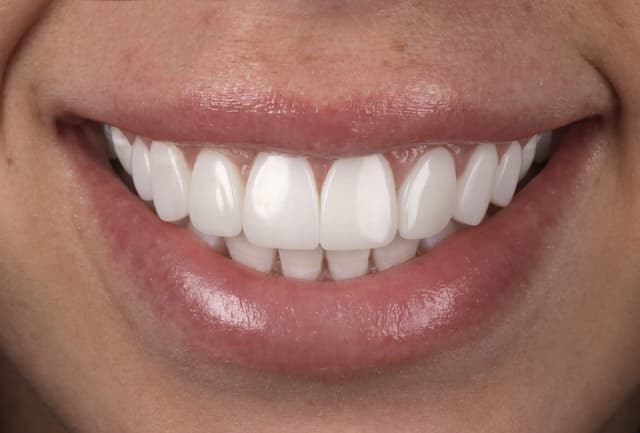 Composite Bonding after