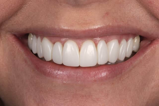 Composite Bonding after