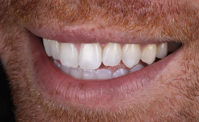 Clear Aligners after
