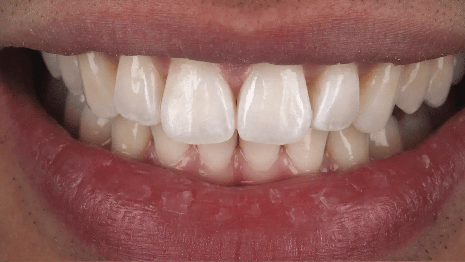Clear Aligners