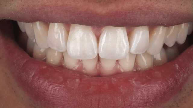 Clear Aligners