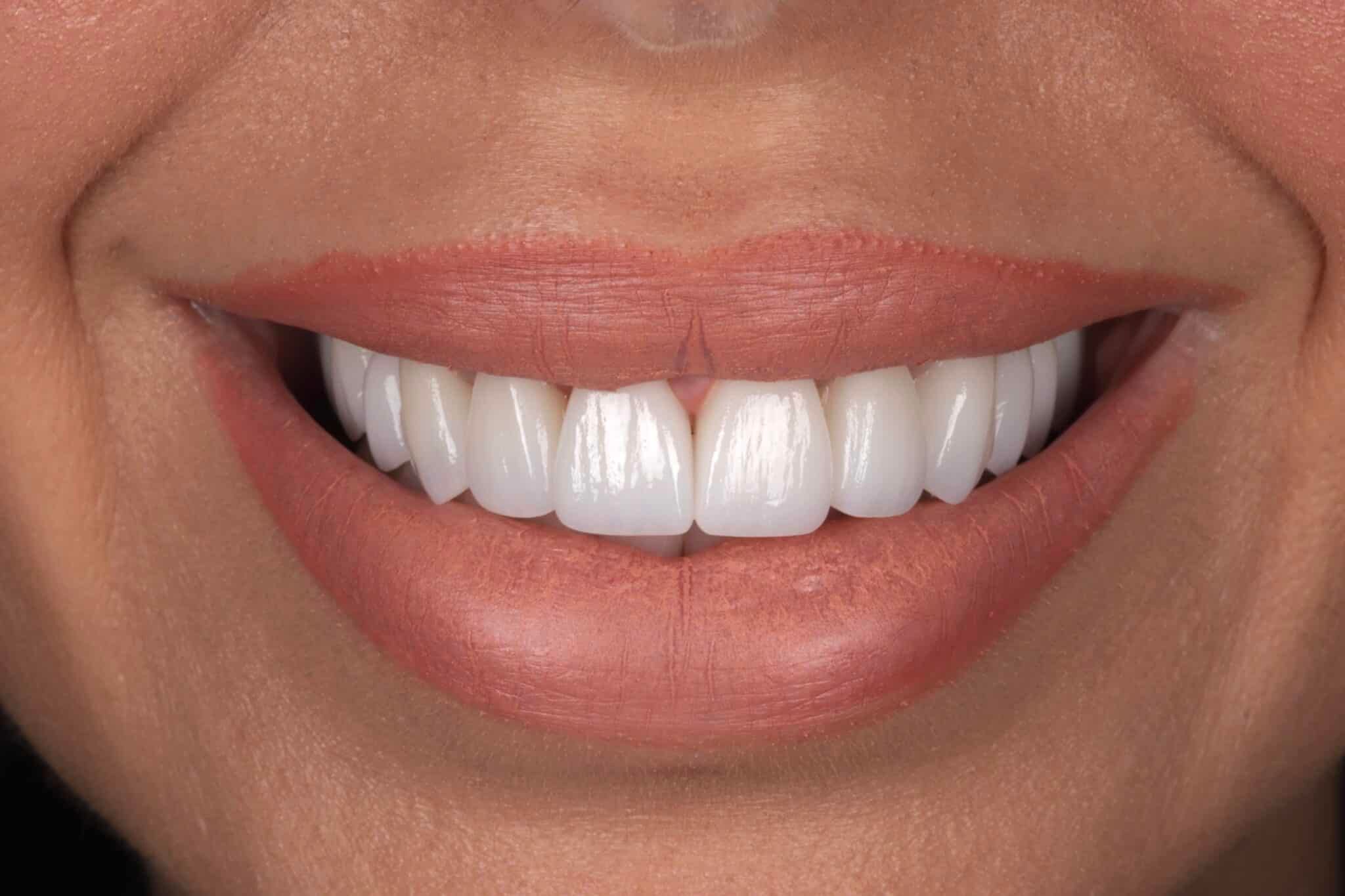 Veneers