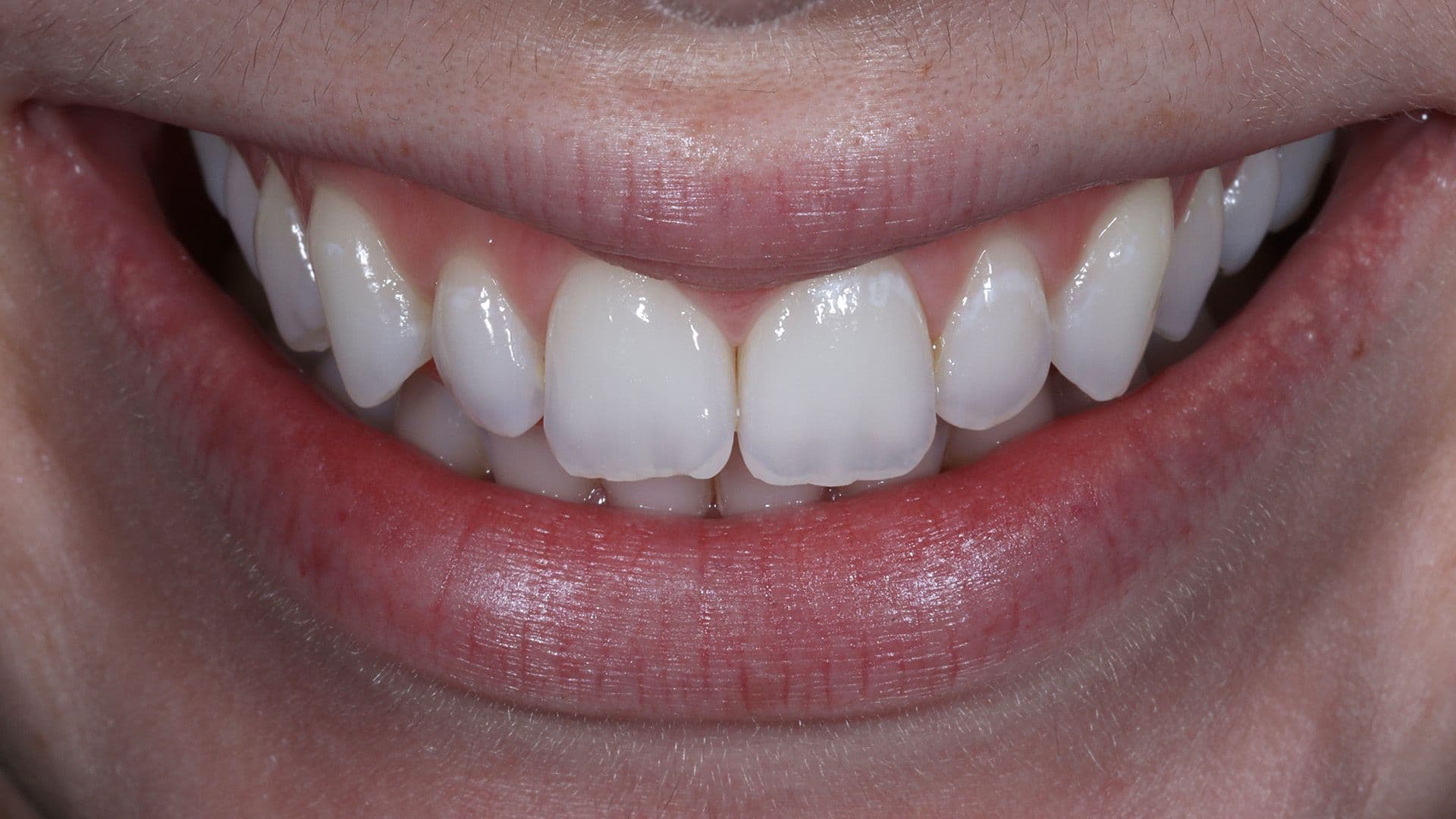 Teeth whitening