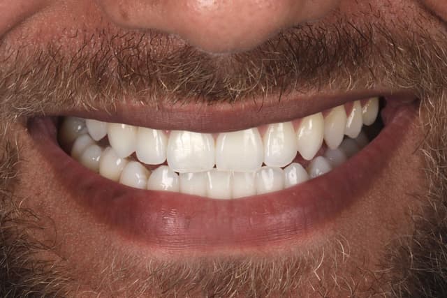 Teeth Whitening after