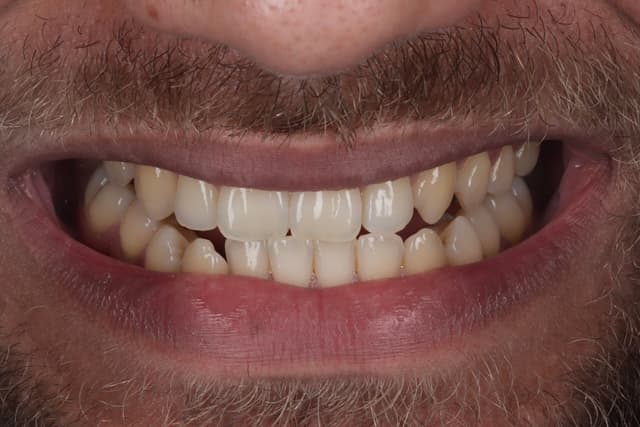 Teeth Whitening before