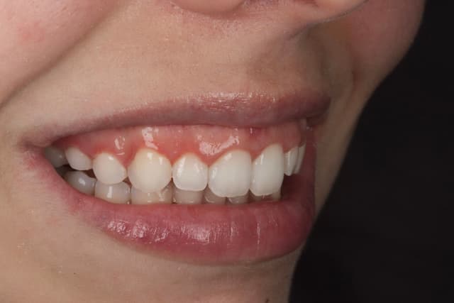 Clear Aligners after