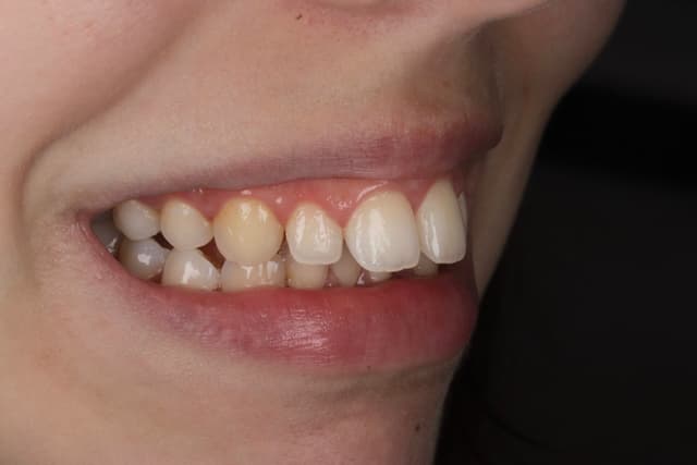 Clear Aligners before