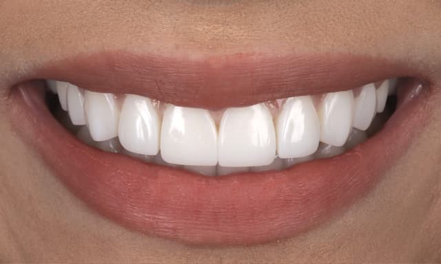 ABC Smile Makeover after