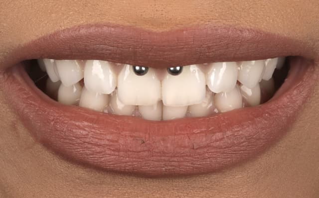ABC Smile Makeover before