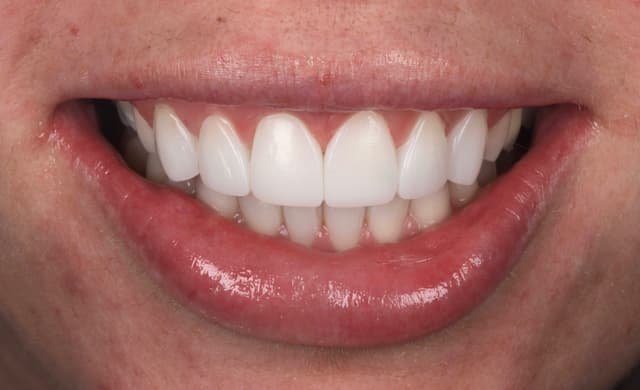 ABC Smile Makeover after