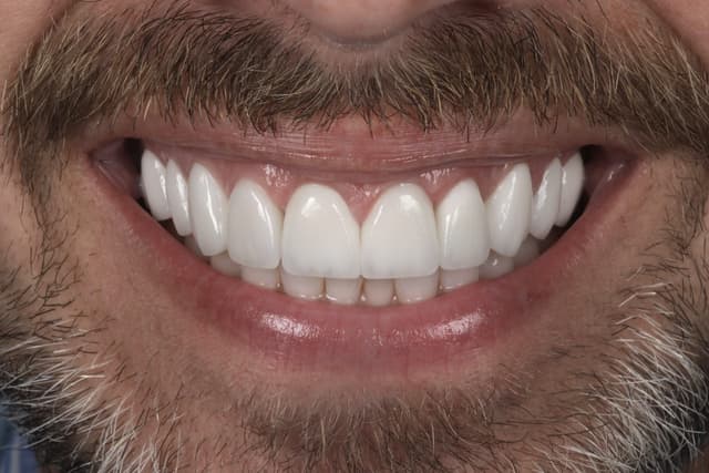 Porcelain Veneers after
