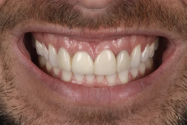 Porcelain Veneers before