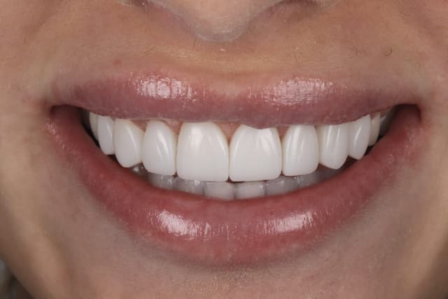 Composite Bonding after