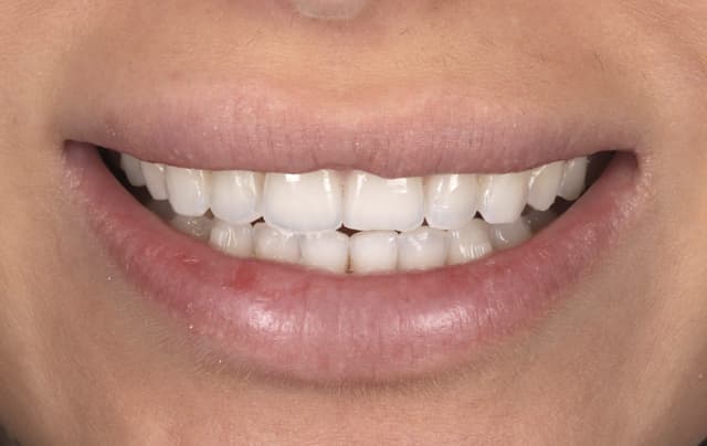 Composite Bonding before