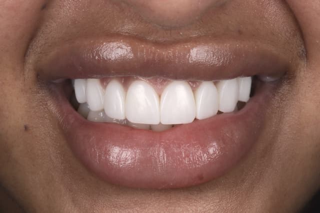 Composite Bonding after
