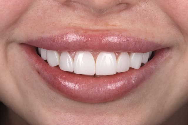 Composite Bonding after