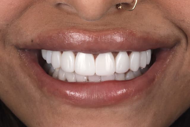 Composite Bonding after