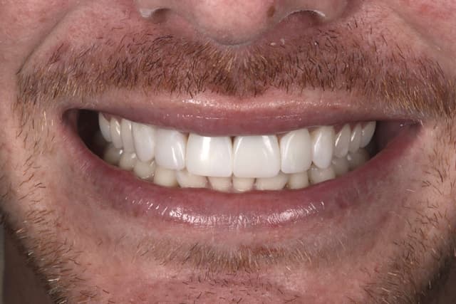 Composite Bonding after
