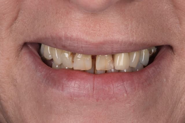 Porcelain Veneers before