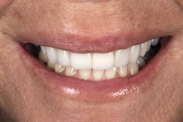 Porcelain after