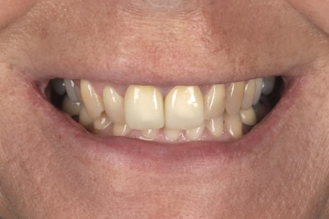 Porcelain before