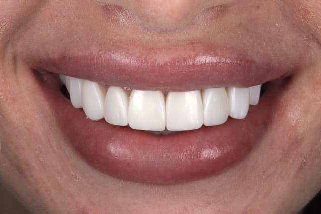 Composite bonding after