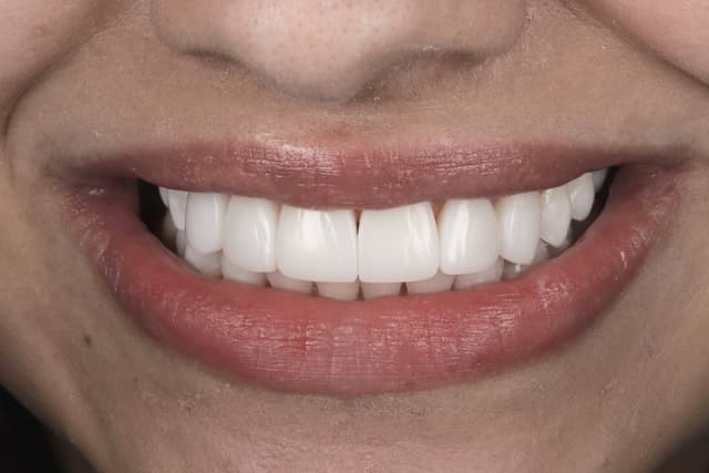 Composite Bonding after
