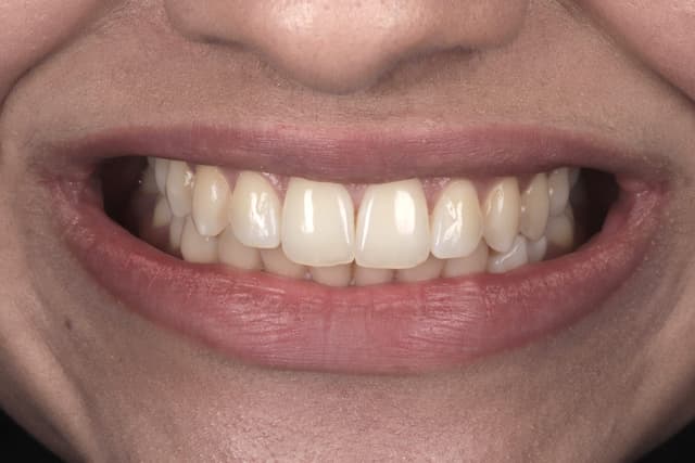 Composite Bonding before