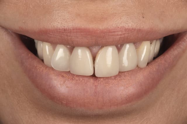 Porcelain before