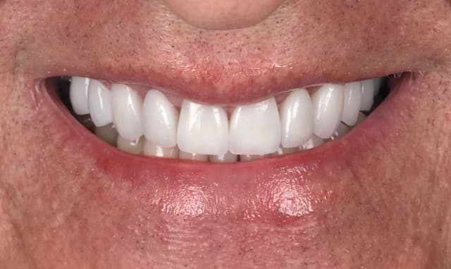 Porcelain after