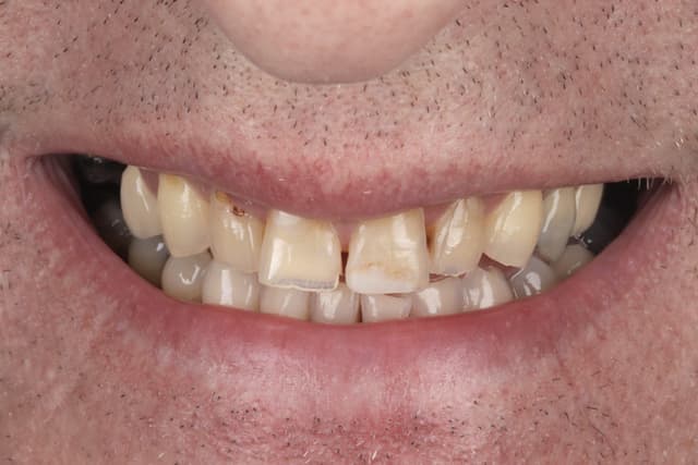 Porcelain before