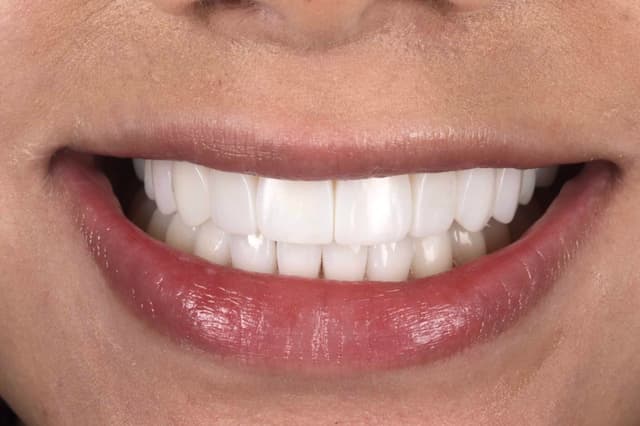 Composite Bonding after