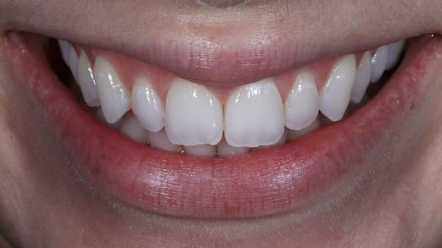 Teeth Whitening after