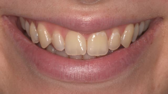 Teeth Whitening before