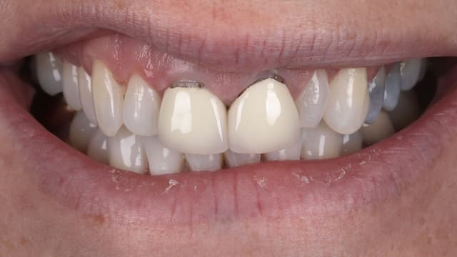 Porcelain before