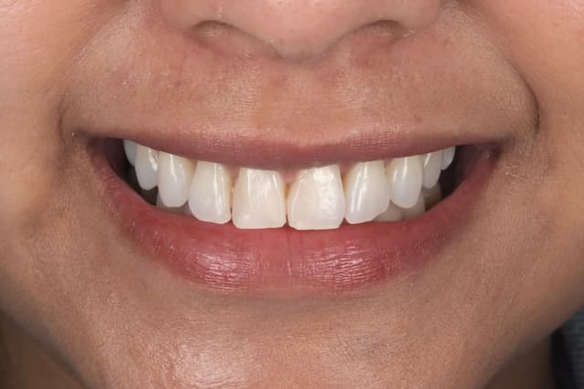 Teeth Whitening before