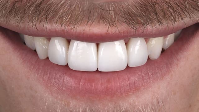Porcelain after