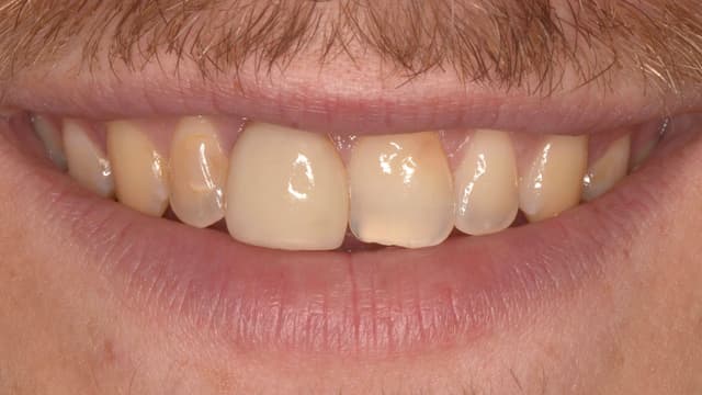 Porcelain before