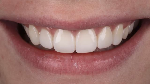 Composite Bonding after