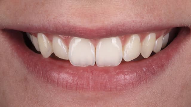 Composite Bonding before