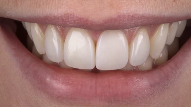 Composite Bonding after