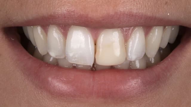 Composite Bonding before