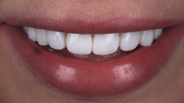 Composite Bonding after
