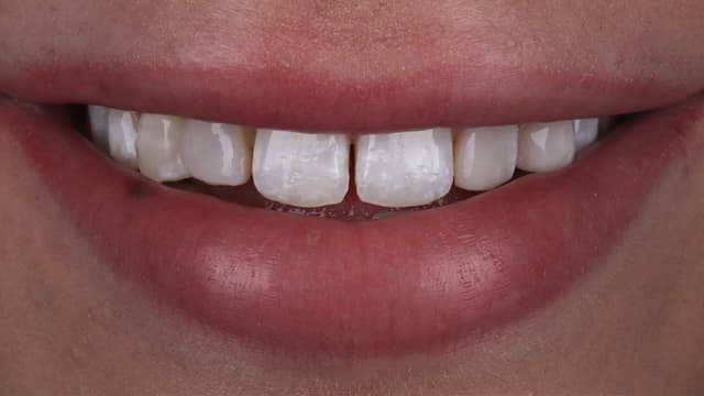 Composite Bonding before