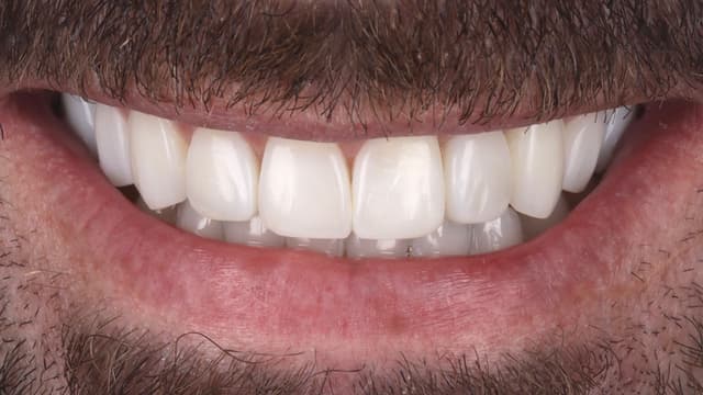 Composite Bonding after
